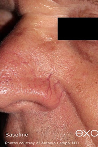 Excel V Vascular Laser Before & After Gallery - Patient 7510144 - Image 1