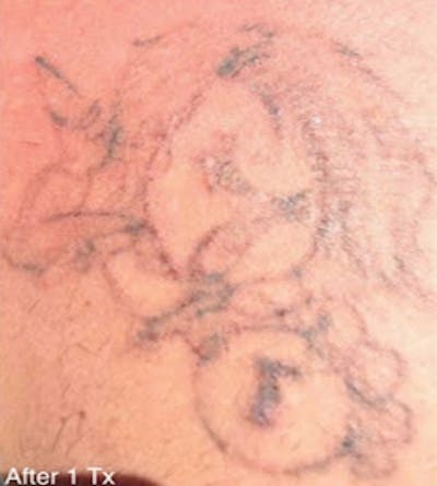 PicoPlus Tattoo Removal Before & After Gallery - Patient 7510145 - Image 2