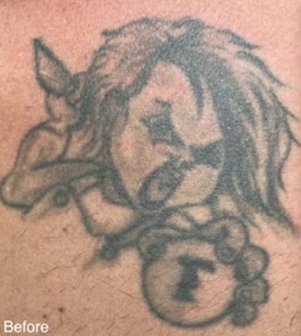 PicoPlus Tattoo Removal Gallery - Patient 7510145 - Image 1