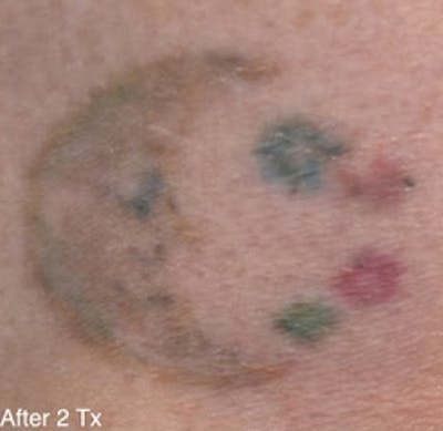 PicoPlus Tattoo Removal Before & After Gallery - Patient 7510146 - Image 2