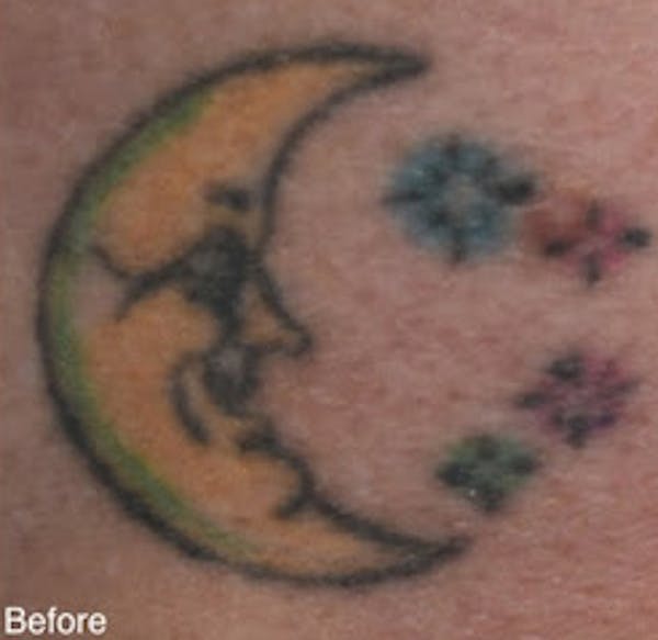 PicoPlus Tattoo Removal Before & After Gallery - Patient 7510146 - Image 1