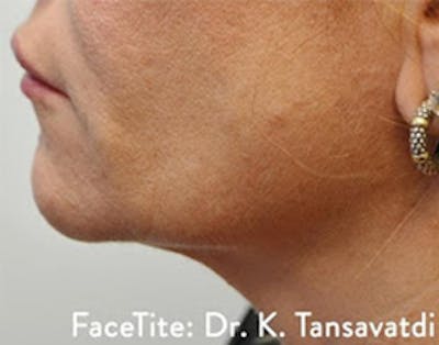 Facetite Before & After Gallery - Patient 7510172 - Image 2