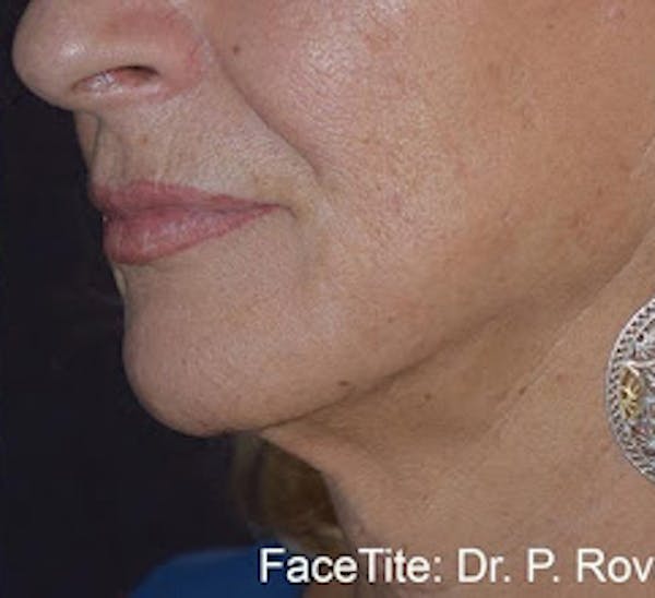 Facetite Before & After Gallery - Patient 7510173 - Image 2