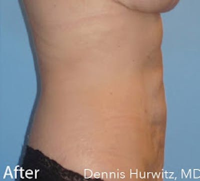 Bodytite Before & After Gallery - Patient 7510178 - Image 2