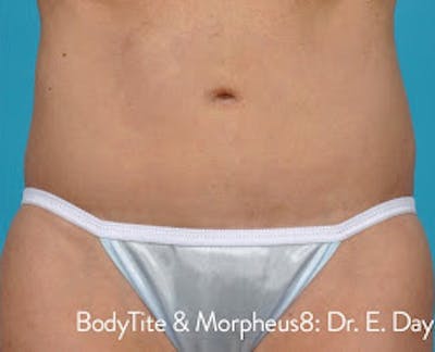 Bodytite Before & After Gallery - Patient 7510179 - Image 2
