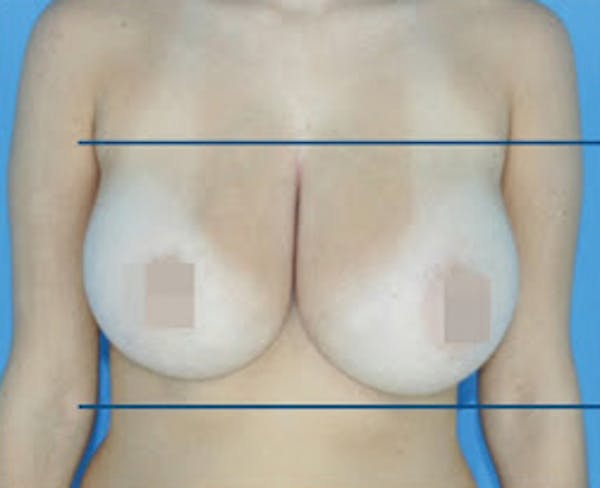 Bodytite Before & After Gallery - Patient 7510180 - Image 1