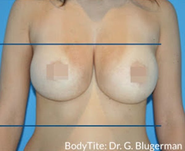 Bodytite Before & After Gallery - Patient 7510180 - Image 2