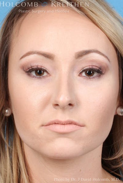 Rhinoplasty Before & After Gallery - Patient 8059726 - Image 1