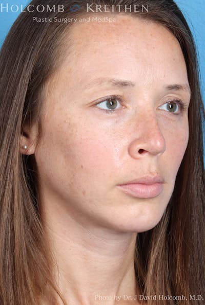 Rhinoplasty Before & After Gallery - Patient 8059725 - Image 4