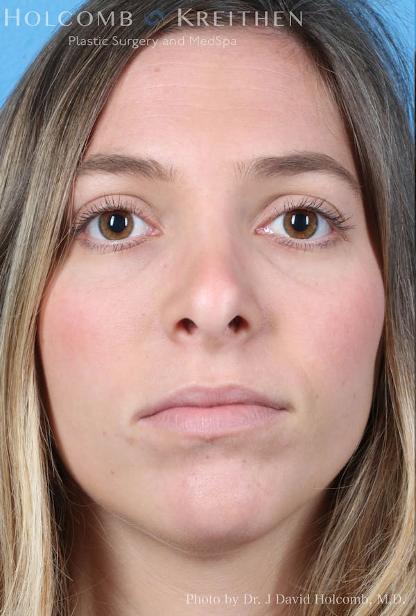 Rhinoplasty Before & After Gallery - Patient 8059727 - Image 1