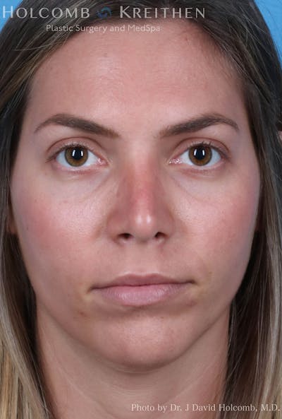 Rhinoplasty Before & After Gallery - Patient 8059727 - Image 2