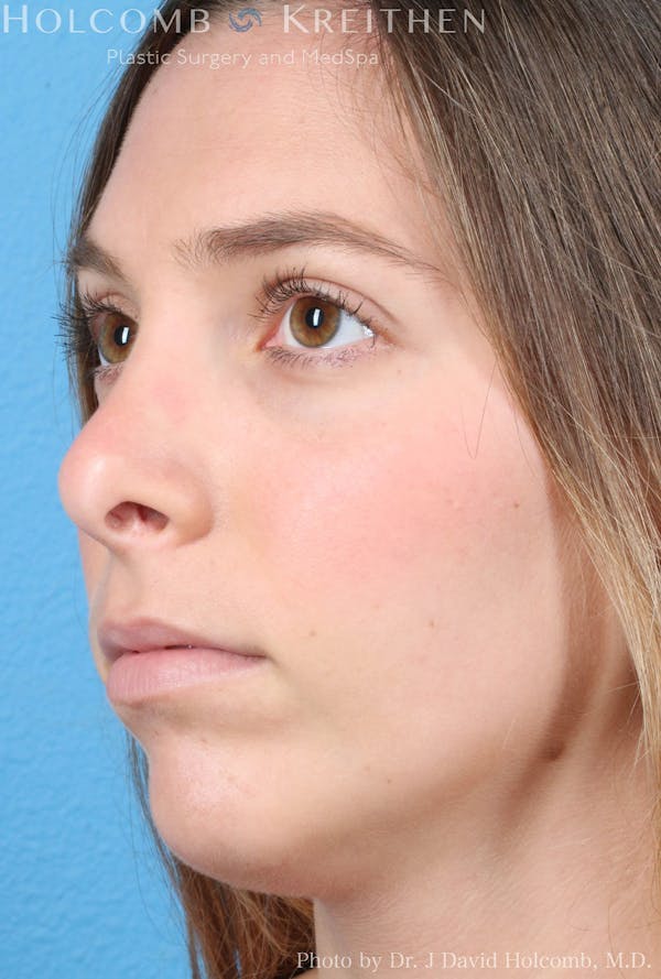 Rhinoplasty Before & After Gallery - Patient 8059727 - Image 3