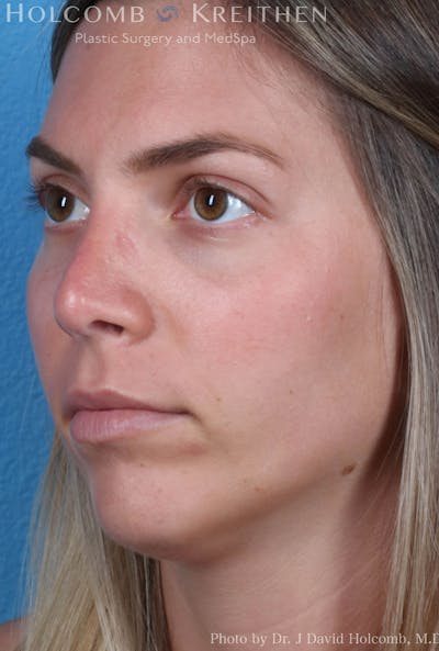 Rhinoplasty Before & After Gallery - Patient 8059727 - Image 4