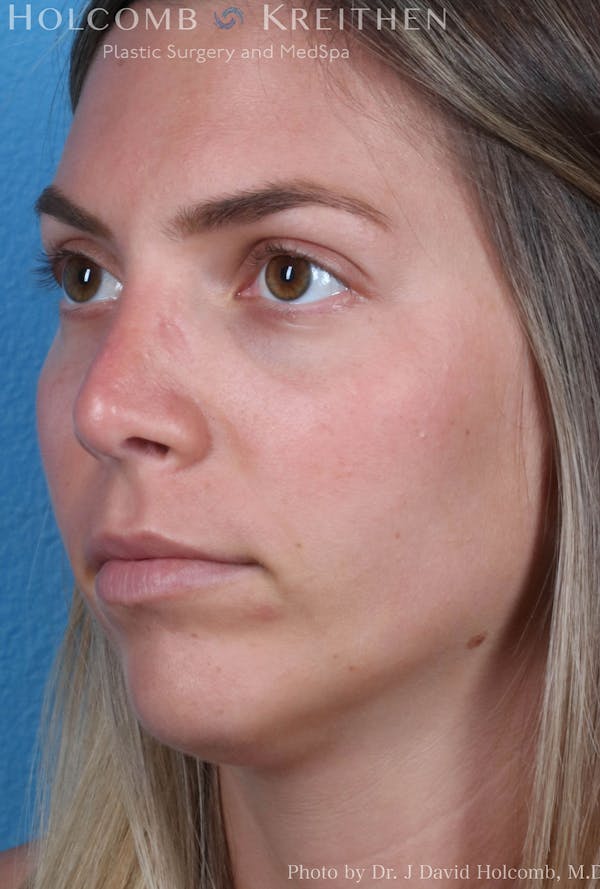 Rhinoplasty Before & After Gallery - Patient 8059727 - Image 4