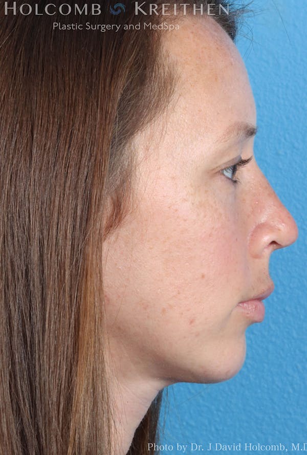 Rhinoplasty Before & After Gallery - Patient 8059725 - Image 6