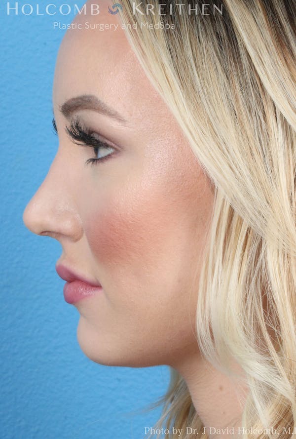 Rhinoplasty Before & After Gallery - Patient 8059726 - Image 6