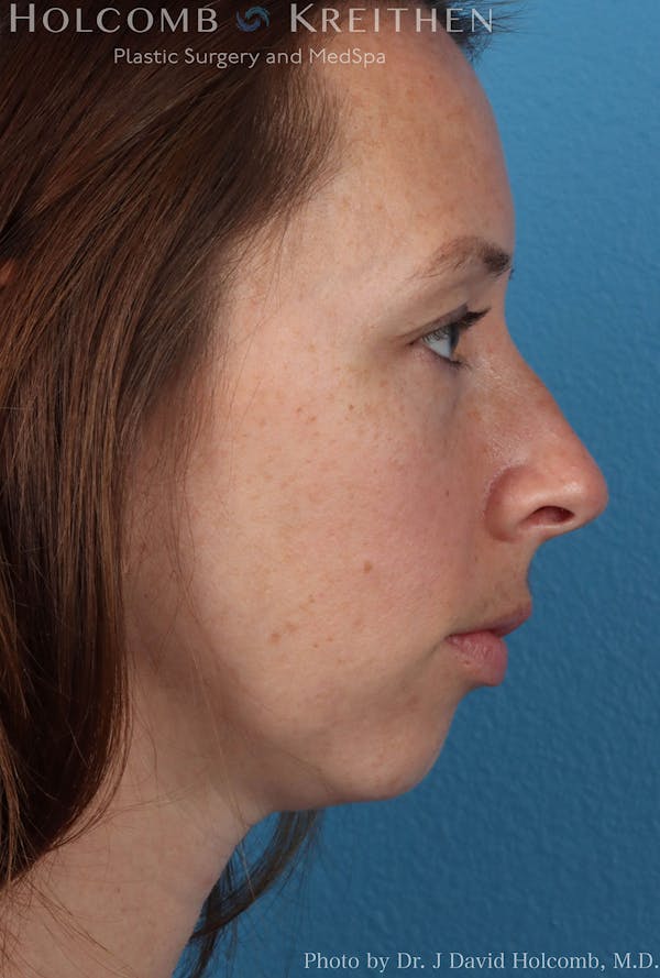 Rhinoplasty Before & After Gallery - Patient 8059725 - Image 5