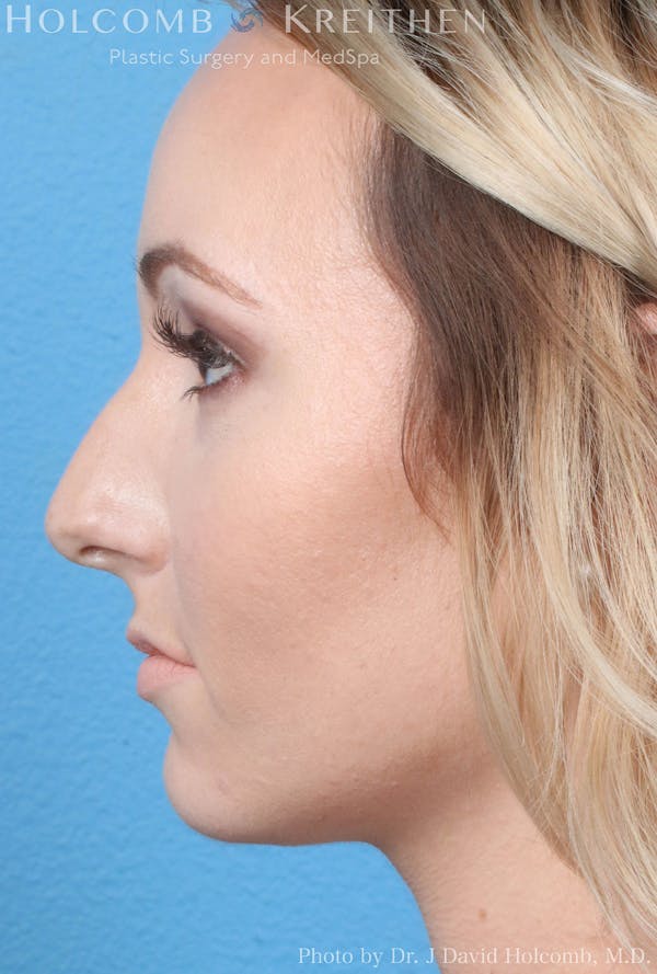 Rhinoplasty Before & After Gallery - Patient 8059726 - Image 5