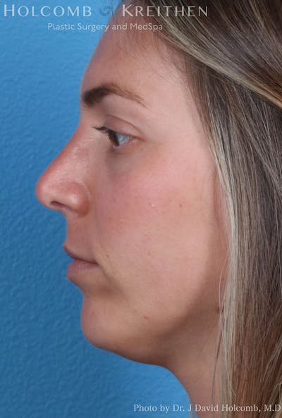 Rhinoplasty Before & After Gallery - Patient 8059727 - Image 6