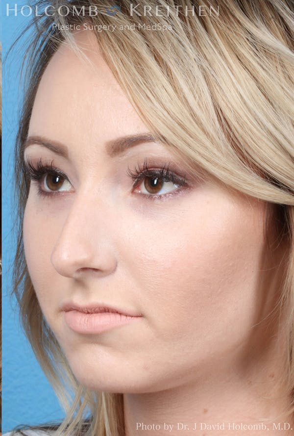 Rhinoplasty Before & After Gallery - Patient 8059726 - Image 3