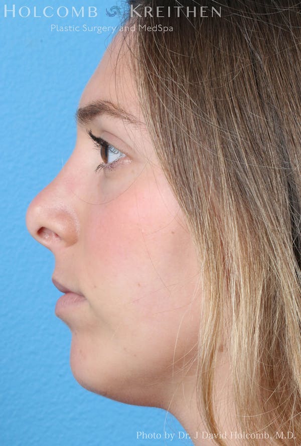 Rhinoplasty Before & After Gallery - Patient 8059727 - Image 5