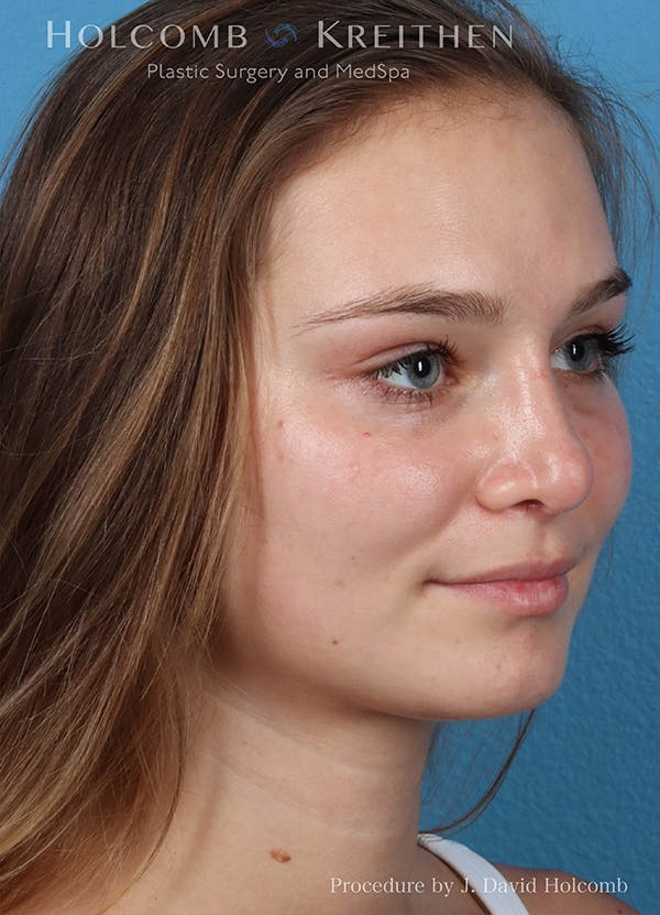 Rhinoplasty Before & After Gallery - Patient 18427354 - Image 4