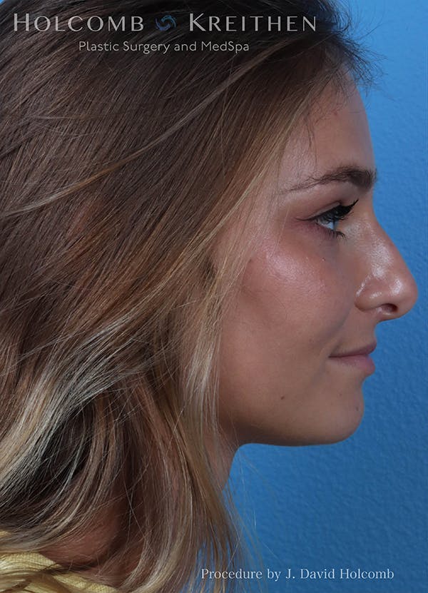 Rhinoplasty Before & After Gallery - Patient 18427354 - Image 5