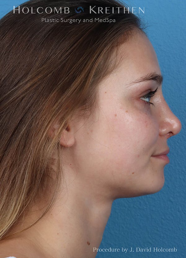 Rhinoplasty Before & After Gallery - Patient 18427354 - Image 6