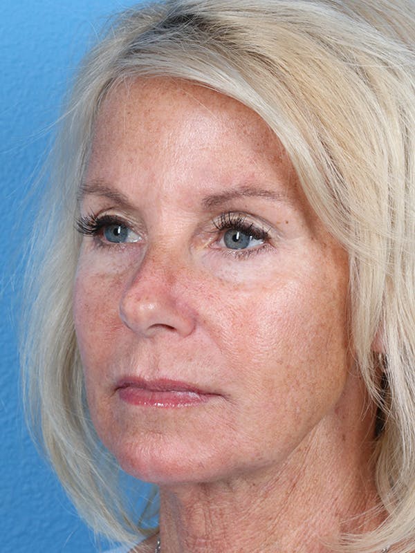Fillers Before & After Gallery - Patient 18906259 - Image 2