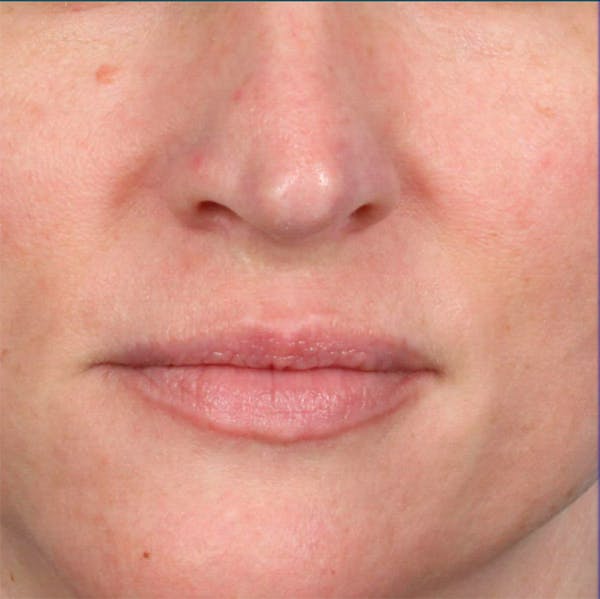 Fillers Before & After Gallery - Patient 18906260 - Image 1