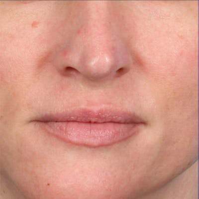 Fillers Before & After Gallery - Patient 18906260 - Image 1