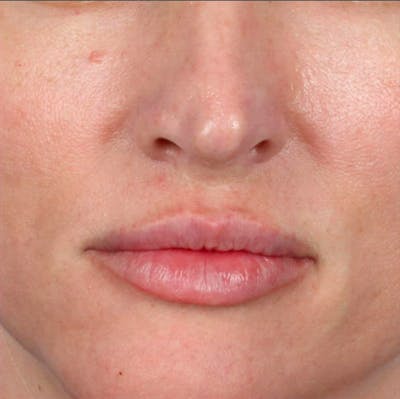 Fillers Before & After Gallery - Patient 18906260 - Image 2