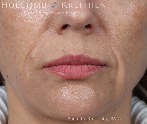Fillers Before & After Gallery - Patient 18906261 - Image 1