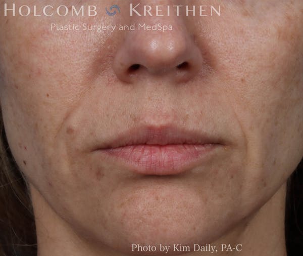 Fillers Before & After Gallery - Patient 18906261 - Image 2