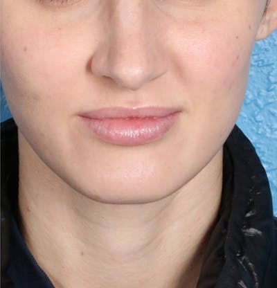 Fillers Before & After Gallery - Patient 18906262 - Image 2
