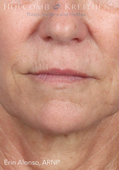 Fillers Gallery - Patient 18906263 - Image 1