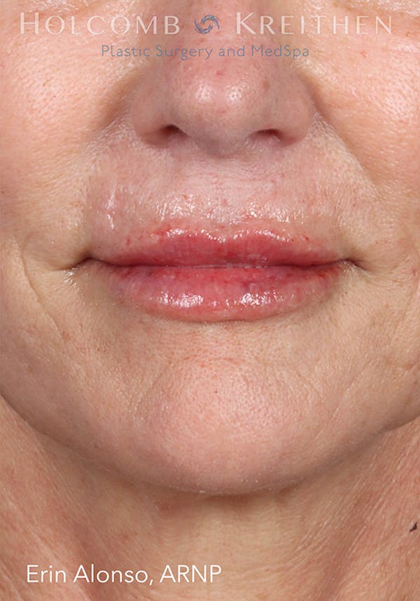 Fillers Before & After Gallery - Patient 18906263 - Image 2