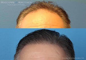 Neograft 2.0