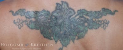 PicoPlus Tattoo Removal Before & After Gallery - Patient 24089681 - Image 1