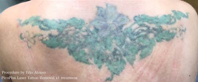 PicoPlus Tattoo Removal Before & After Gallery - Patient 24089681 - Image 2