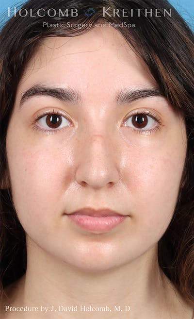 Rhinoplasty Before & After Gallery - Patient 24311394 - Image 1