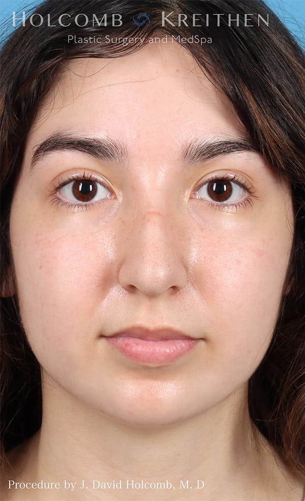 Rhinoplasty Before & After Gallery - Patient 24311394 - Image 1