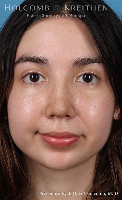 Rhinoplasty Before & After Gallery - Patient 24311394 - Image 2
