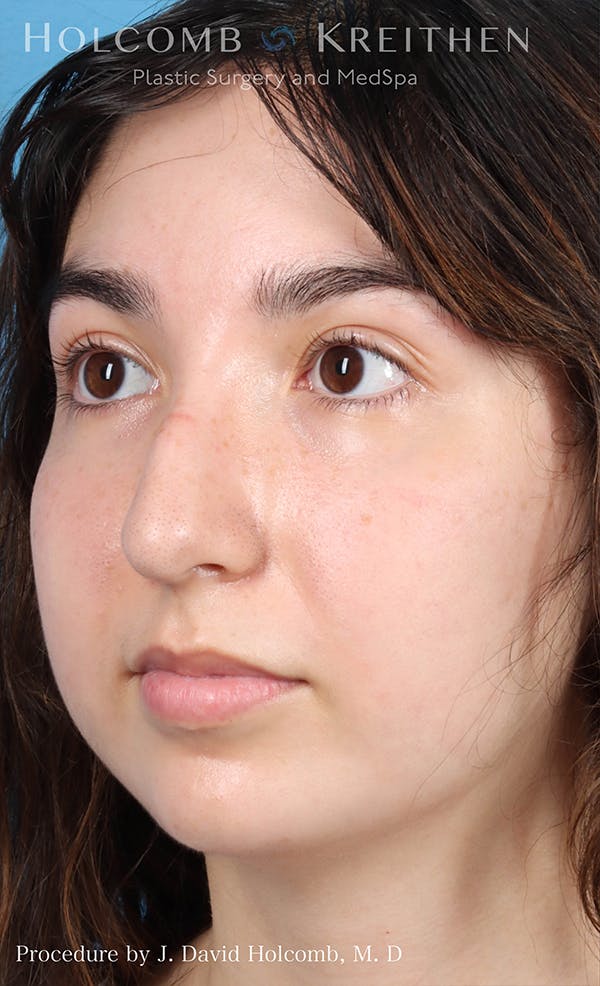 Rhinoplasty Before & After Gallery - Patient 24311394 - Image 3