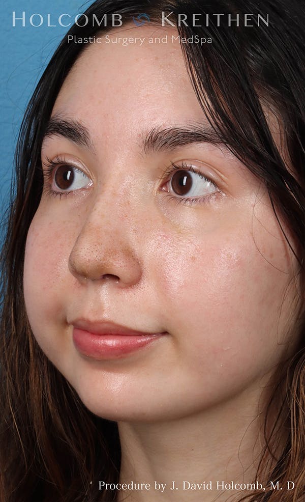 Rhinoplasty Before & After Gallery - Patient 24311394 - Image 4