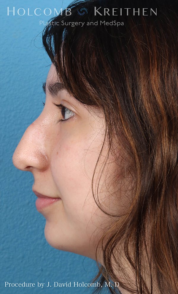 Rhinoplasty Before & After Gallery - Patient 24311394 - Image 5
