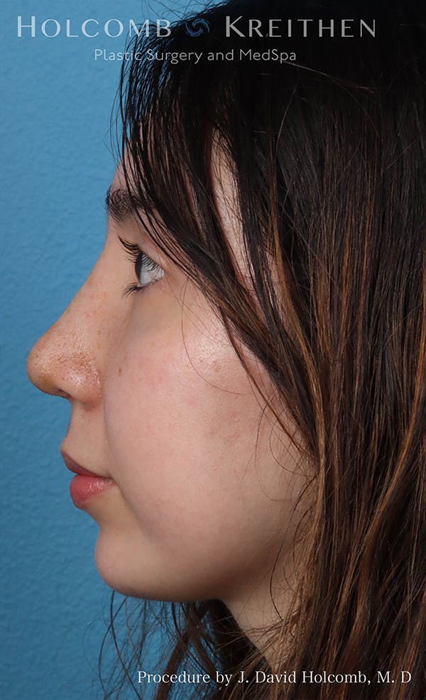 Rhinoplasty Before & After Gallery - Patient 24311394 - Image 6