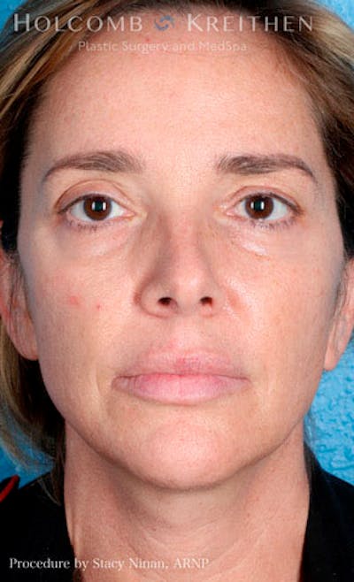 Fillers Before & After Gallery - Patient 26333057 - Image 1