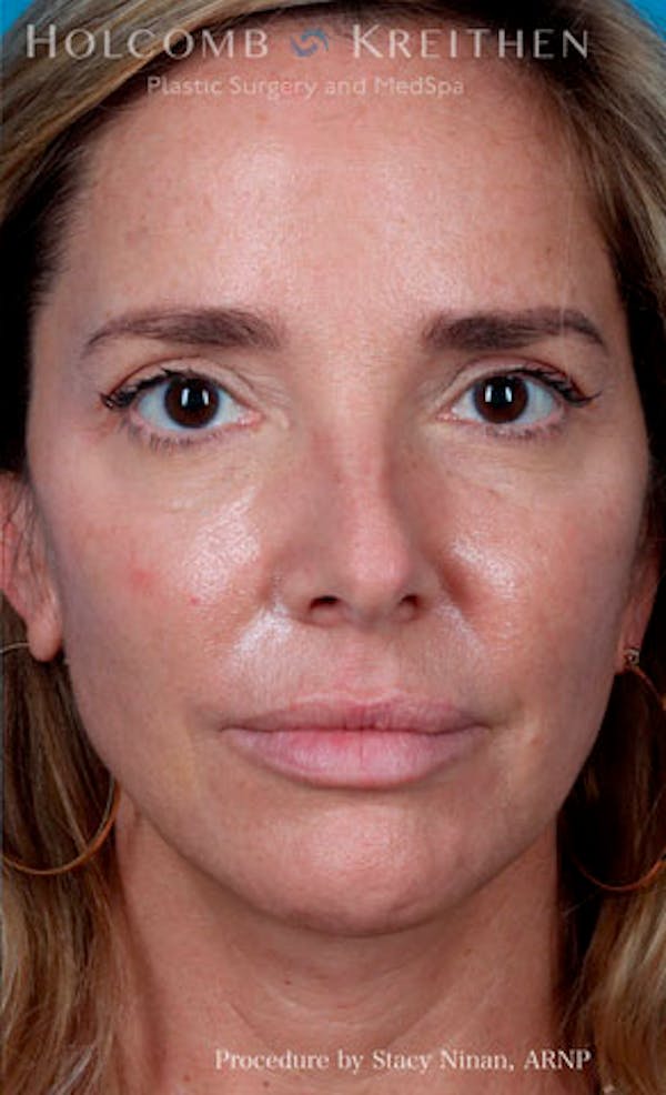 Fillers Before & After Gallery - Patient 26333057 - Image 2