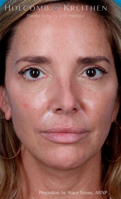 Fillers Before & After Gallery - Patient 26333057 - Image 2